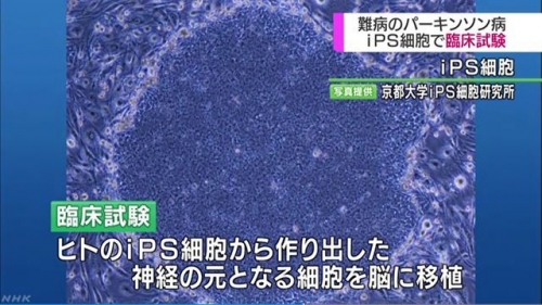 韓国人「日本、万能幹細胞にパーキンソン病治療の臨床試験推進」