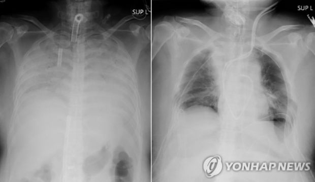 コロナ後遺症の日本人女性、夫と息子の肺を移植…世界初＝韓国の反応