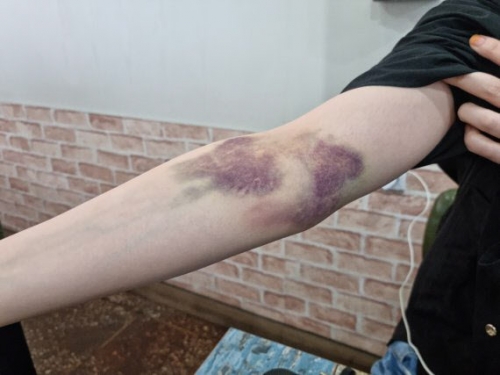 【緊急速報】ワクチン交差接種した韓国人の腕の血管が爆発
